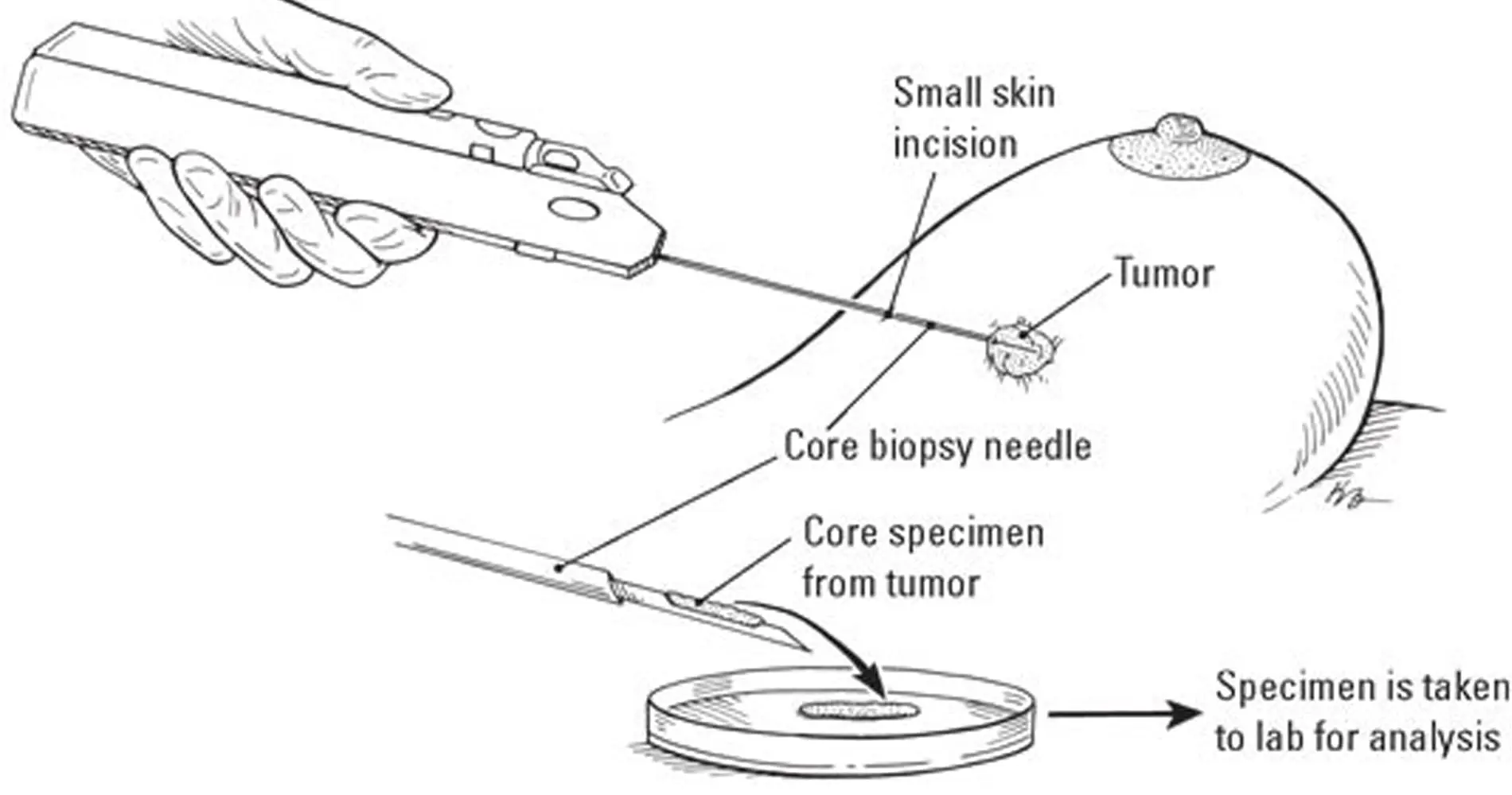 بیوپسی پستان